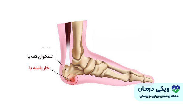 خار پاشنه