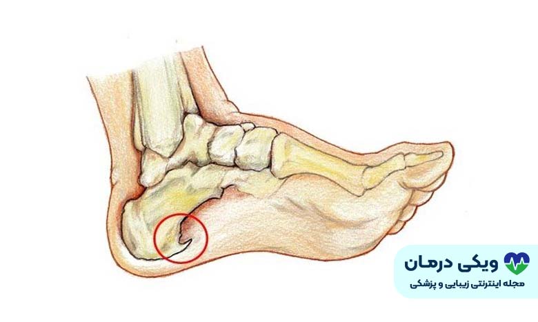 زائده پاشنه