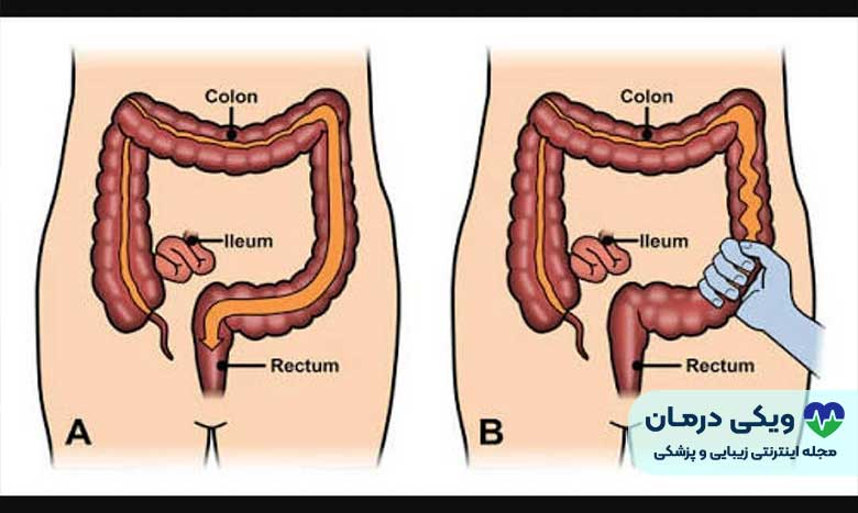 سندروم روده تحریک پذیر