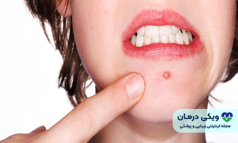 علل جوش پریودی
