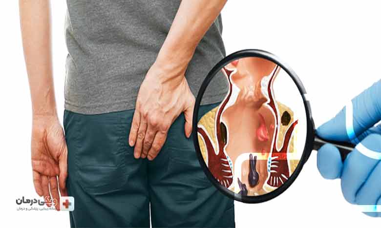 هموروئید ترومبوزه