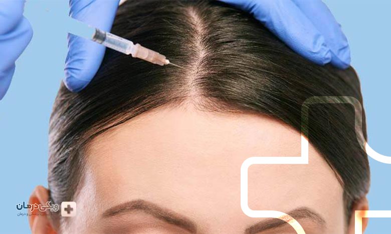 مزوتراپی مو چیست؟