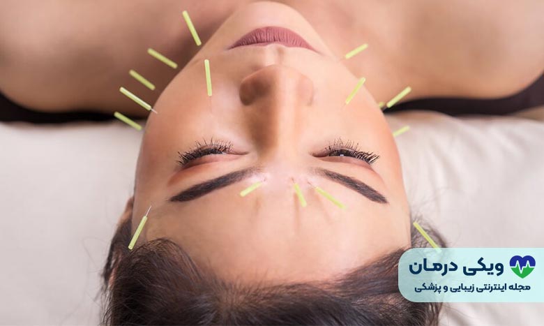 فیشیال طب سوزنی (Acupuncture Facial)