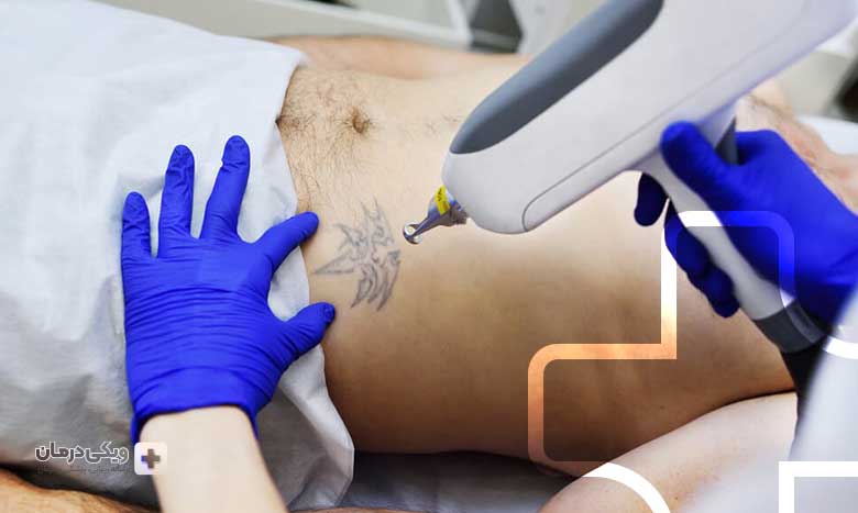 انواع لیزر برای پاک کردن تاتو