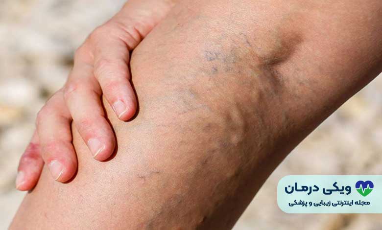 واریس پا