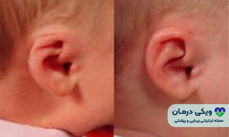 اتوپلاستی گوش مخفی