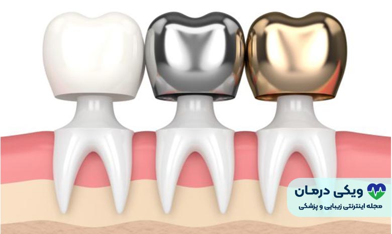 روکش تمام فلزی
