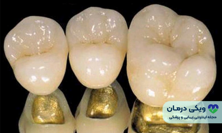 روکش pfm