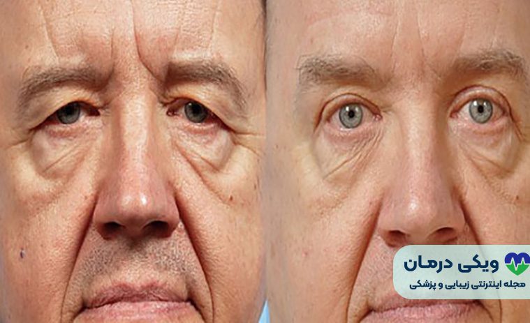 هزینه عمل بلفاروپلاستی