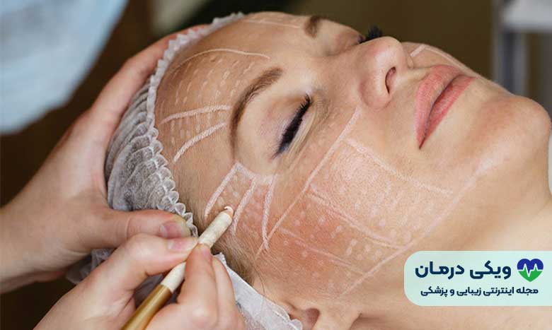 مادلینگ صورت چیست