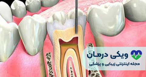 مراقبت های پس از درمان ریشه