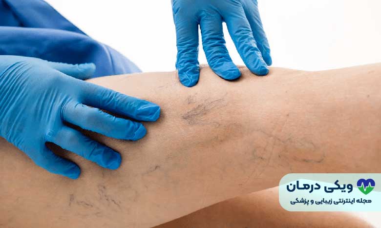 درمان واریس پا