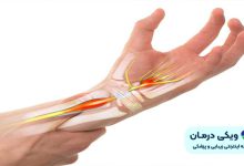 درد مچ دست