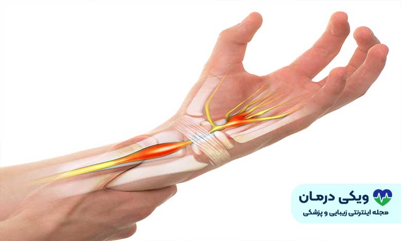 درد مچ دست