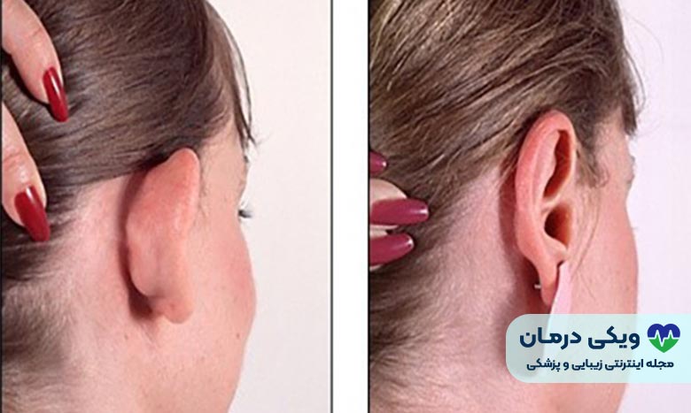 اتوپلاستی دفورمیتی بزرگ