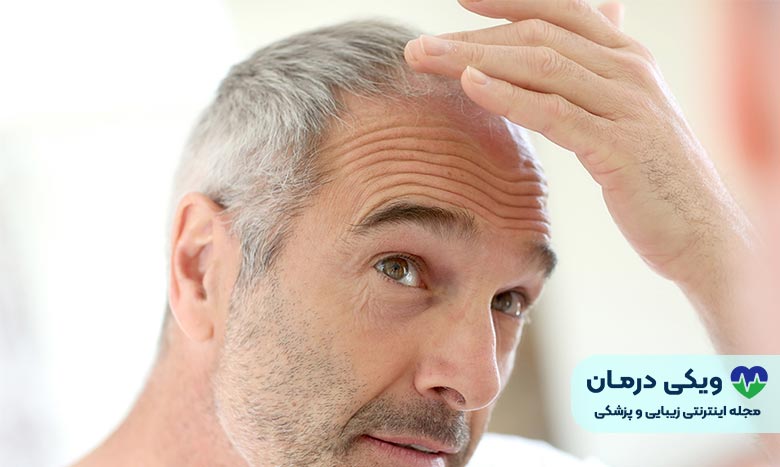 ریزش مو از جلو سر