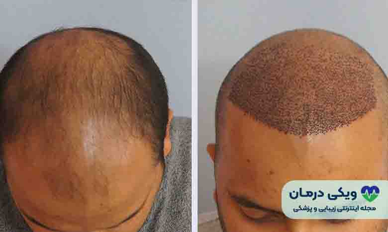 بهترین روش کاشت مو