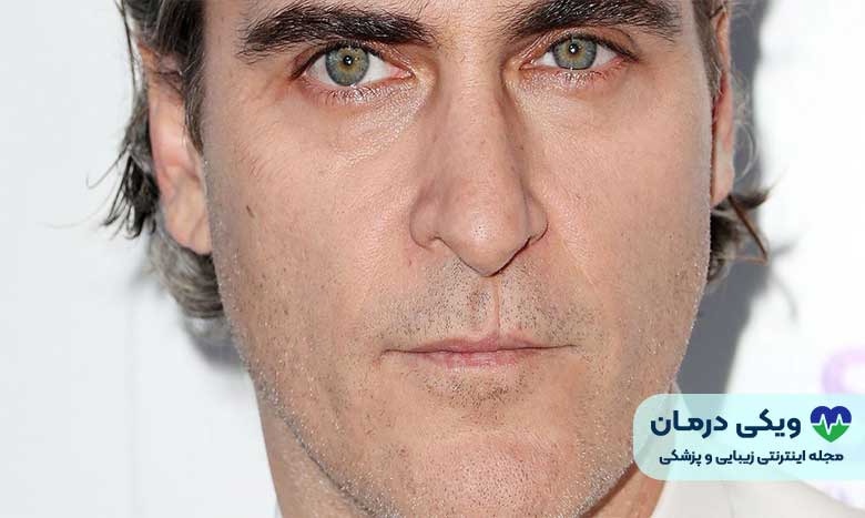 جراحی لب شکری در بزرگسالان