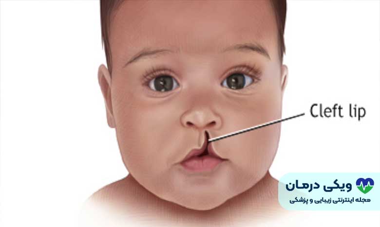 لب شکری یا cleft lip