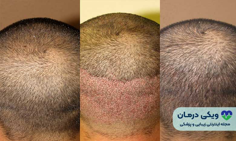 عوارض کاشت مو