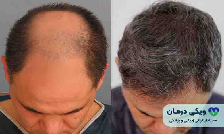 فیلم کاشت مو به روش sut