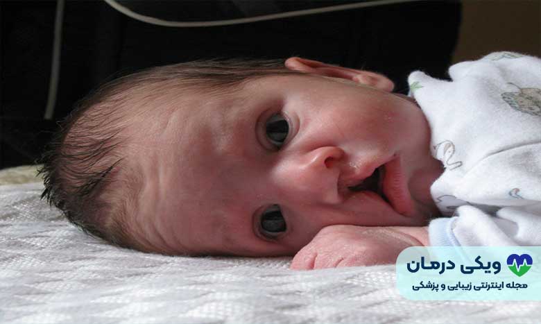 لب شکری یا cleft lip