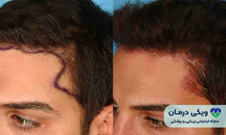 مراحل کاشت مو به روش SUT