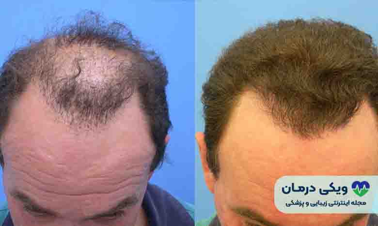 نحوه کاشت مو به روش SUT