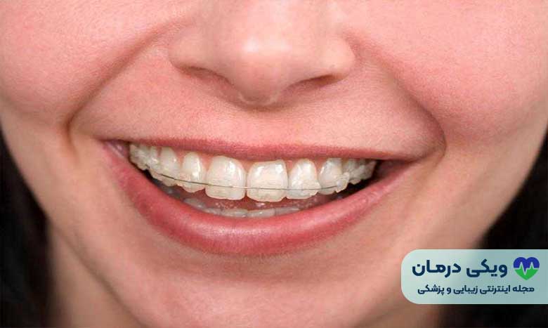 نگهدارنده ثابت پلاستیکی