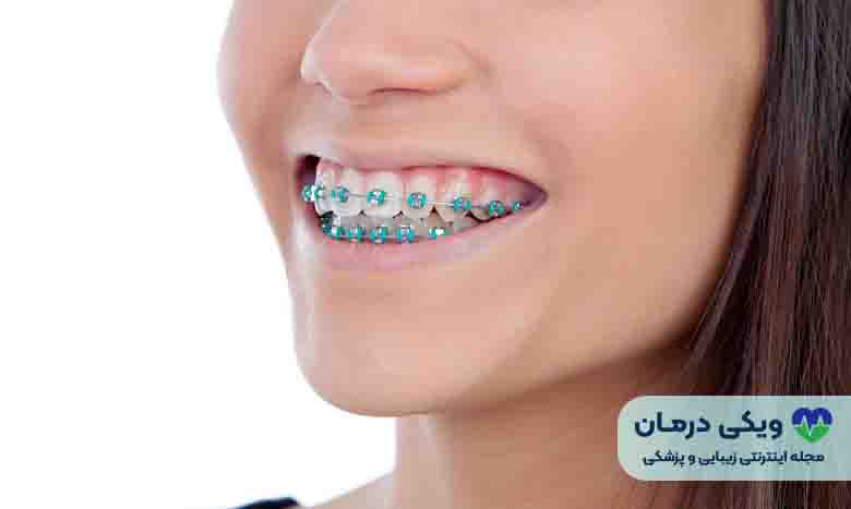 هزینه ارتودنسی