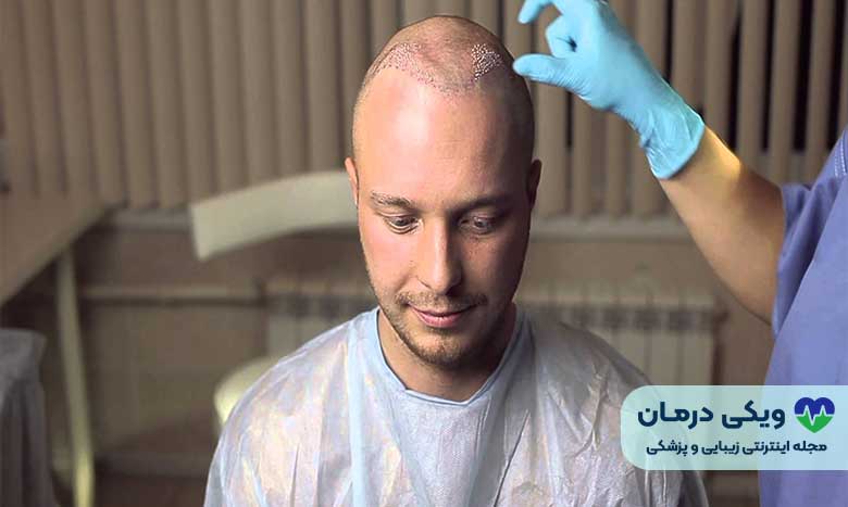 کاشت مو به روش غیر جراحی