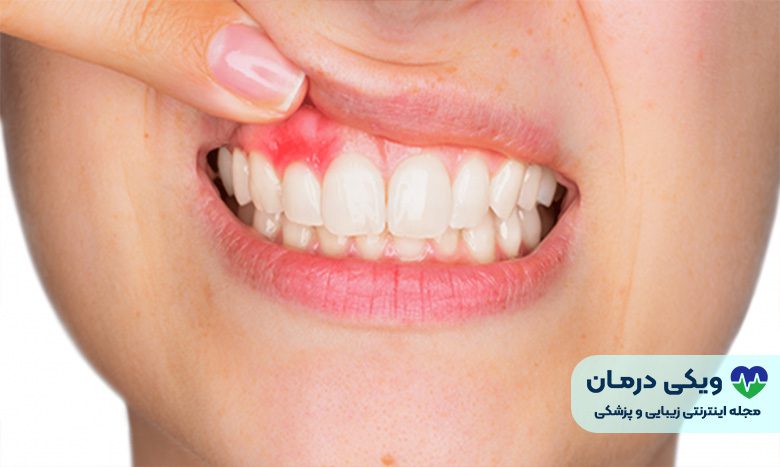 علت ایجاد کیست دندان عقل