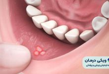 آفت دهان چیست؟