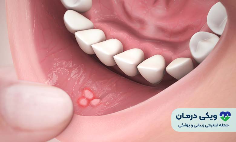 آفت دهان چیست؟