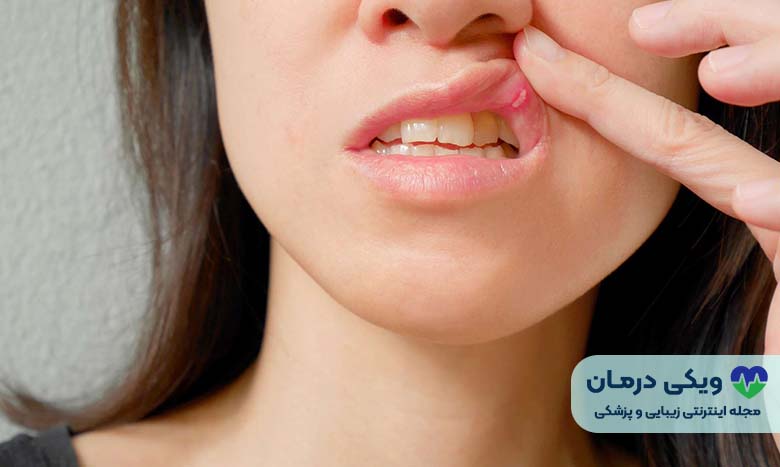 علل آفت دهان