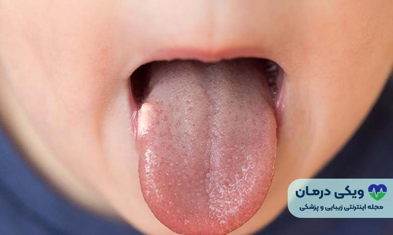 علل آفت دهان