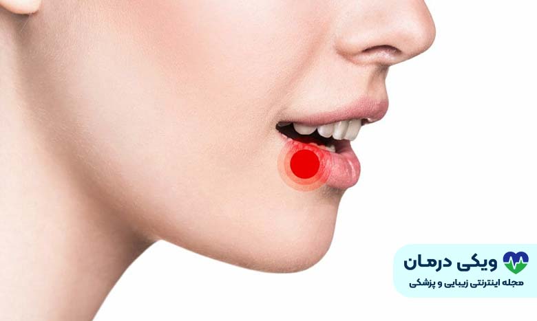 آفت دهان 
