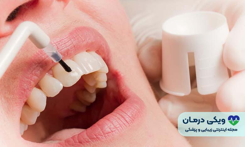 فلوراید تراپی چیست؟
