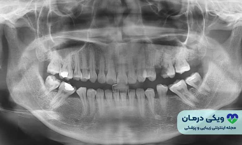 تجهیزات عکس OPG