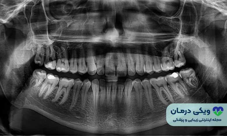 قیمت عکس OPG دندان چیست؟