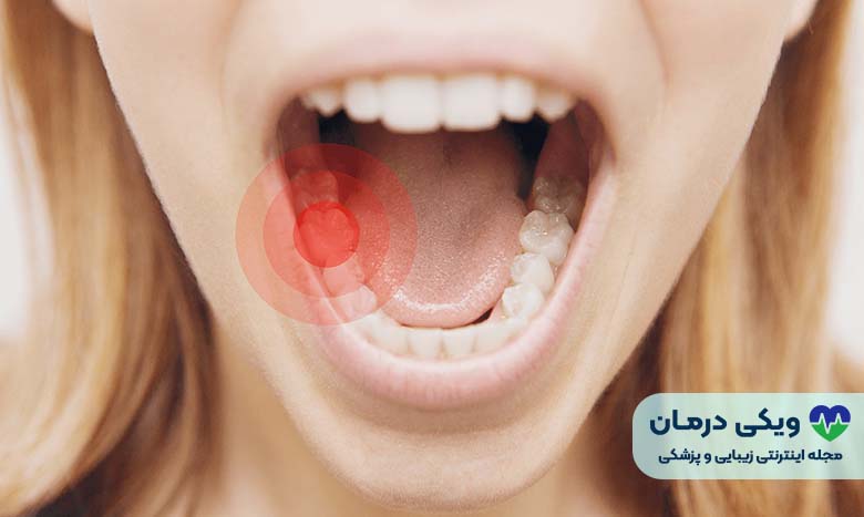 نحوه درمان دندان درد با سیر