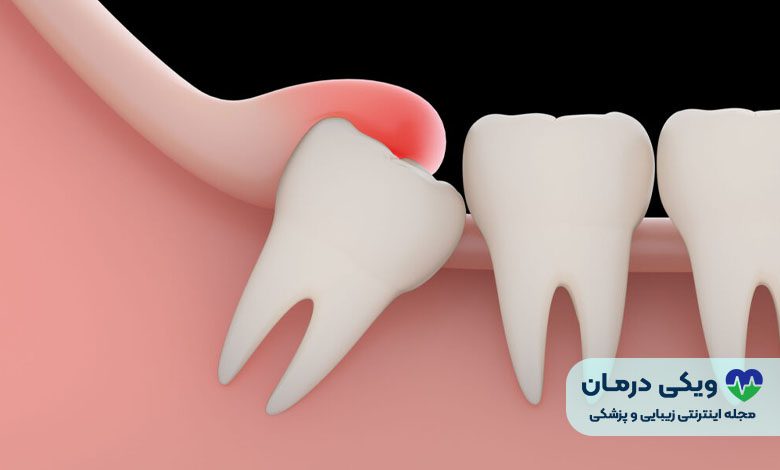 دندان عقل نهفته چیست؟