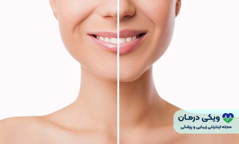 چگونگی انجام بوتاکس لب