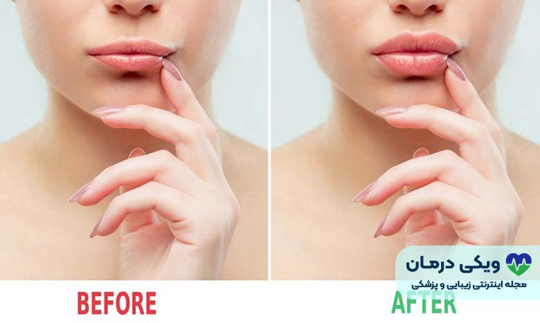 تاثیرات بوتاکس لب