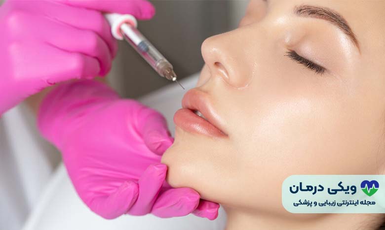 بوتاکس لب