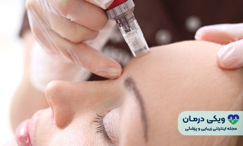 مزونیدلینگ چیست؟