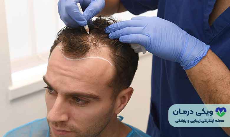ویژگی بهترین دکتر کاشت مو