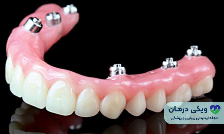 روند قرار گیری دندان مصنوعی ثابت