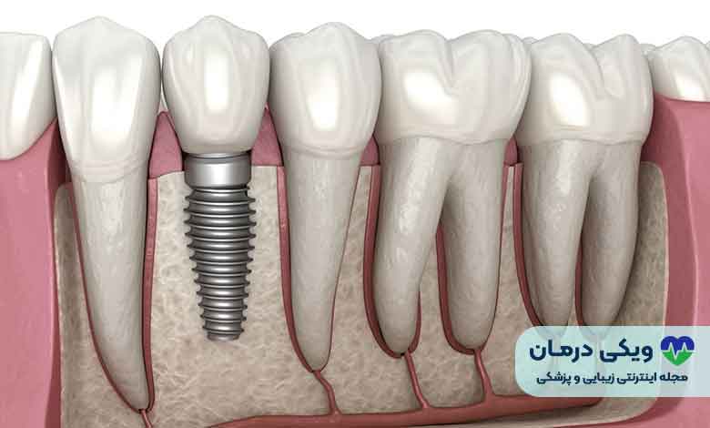 دندان مصنوعی ثابت
