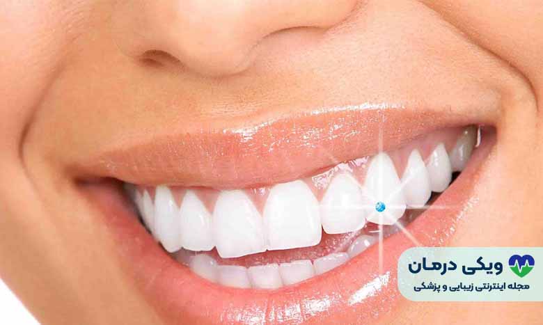 نگین دندان چیست؟